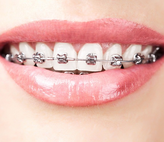 Close-up of woman’s mouth with traditional metal braces in Lake Zurich, IL