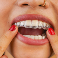Woman inserting clear aligner