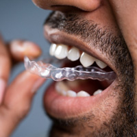 Man inserting a clear aligner into his mouth