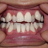Crowded teeth