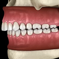 Digital image of an overbite