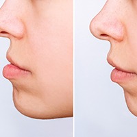 Up-close view of a before-and-after underbite