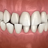Digital view of a crossbite