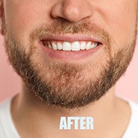Man before and after gum recontouring in Lake Zurich
