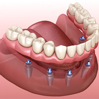 Implant dentures in Lake Zurich
