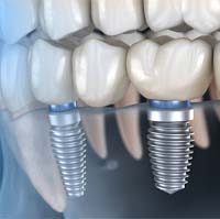 Implant bridge in Lake Zurich