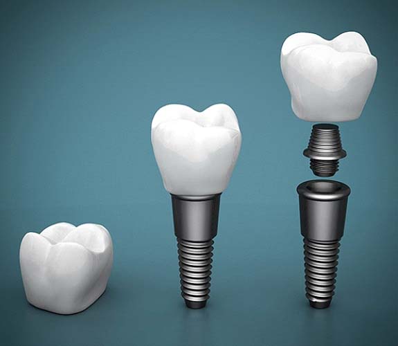 Understanding cost of dental implants in Lake Zurich