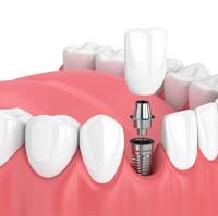 Dental implant in Lake Zurich