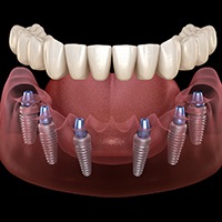 Implant denture in Lake Zurich