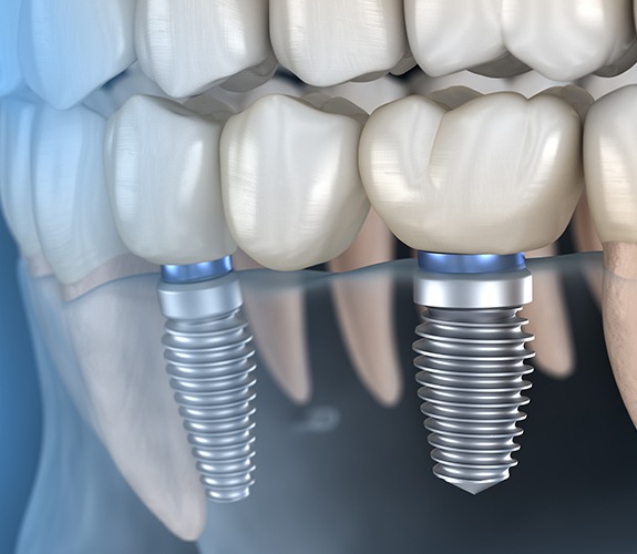 Animated smile with a dental implant supported fixed bridge