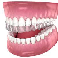 Digital image of a clear aligner sitting on a row of top teeth