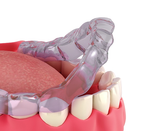 Animated Invisalign clear braces tray placed on teeth
