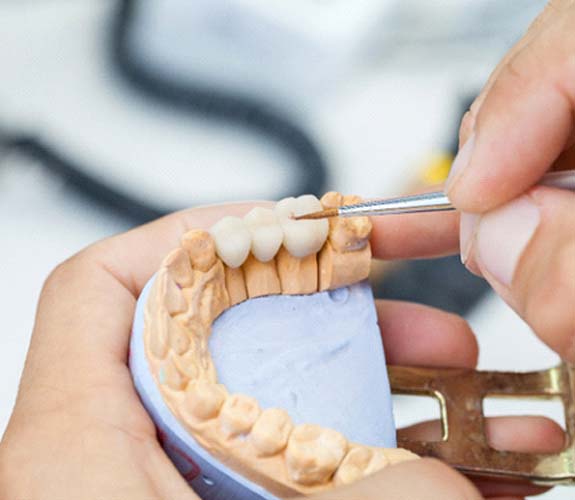 Dental bridge in Lake Zurich being created