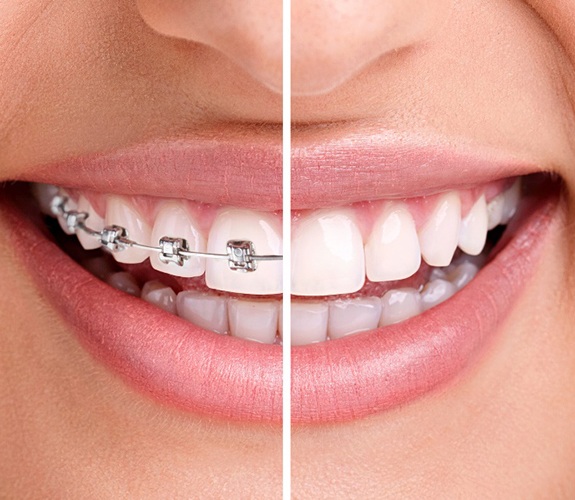 before and after closeup of patient with orthodontics in lake Zurich, IL 