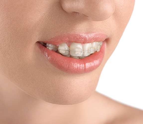 Closeup of smile with tooth colored braces