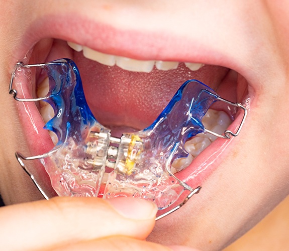Patient placing an orthodontic appliance