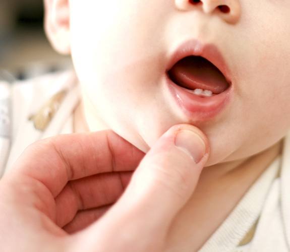 Baby examined for lip and tongue tie
