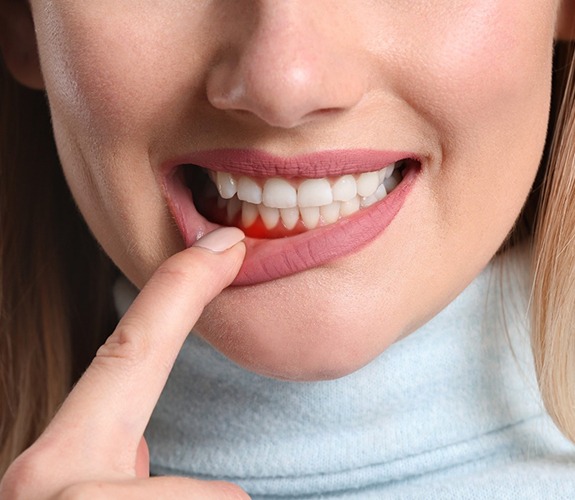 Woman pulling down lip showing signs of gum disease in Lake Zurich, IL