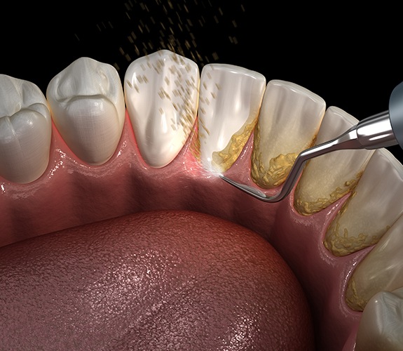 Animated smile receiving scaling and root planing periodontal therapy