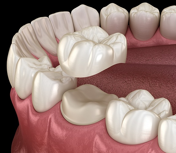 Animated dental crown placement