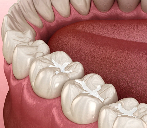 Tooth-colored fillings in the lower arch