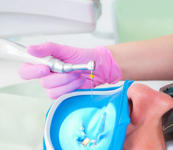 Dentist performing a root canal on a patient