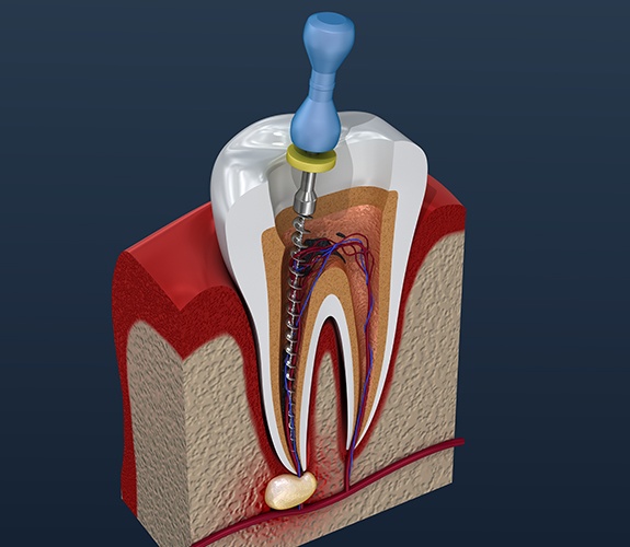 Animated tooth during root canal therapy