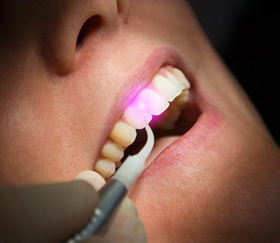 Soft tissue laser dentistry