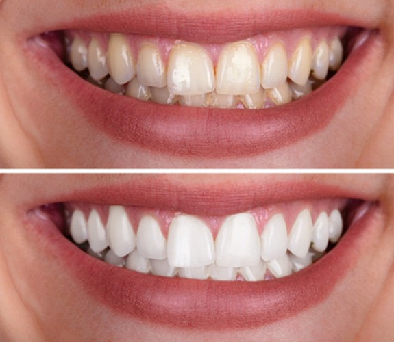 Before and after image of teeth whitening 