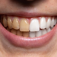 Before and after teeth whitening