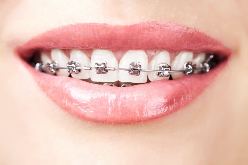 Close-up of teeth with traditional metal braces