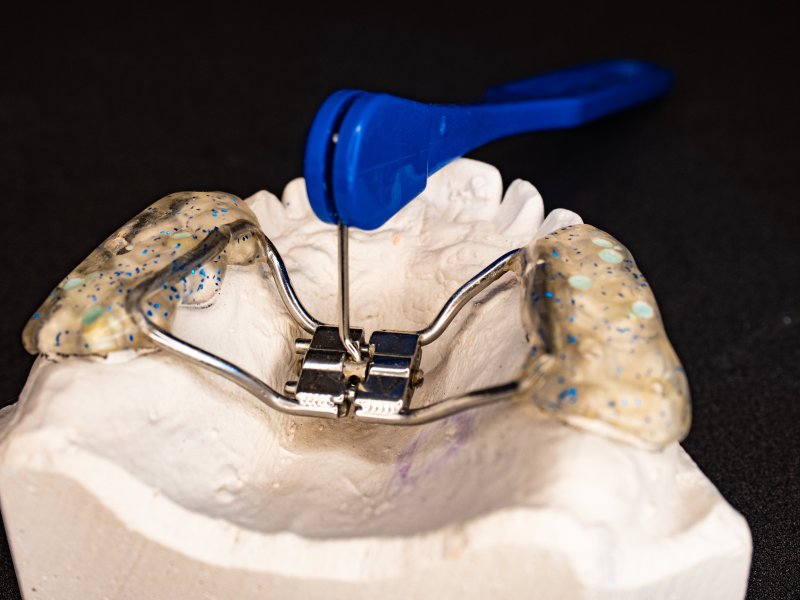 Dental expander on a ceramic model