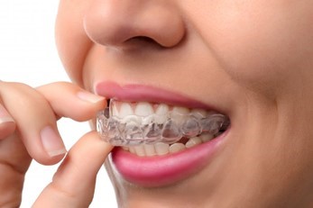 woman inserting Invisalign aligner