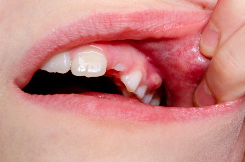 up-close view of a bump on the gums
